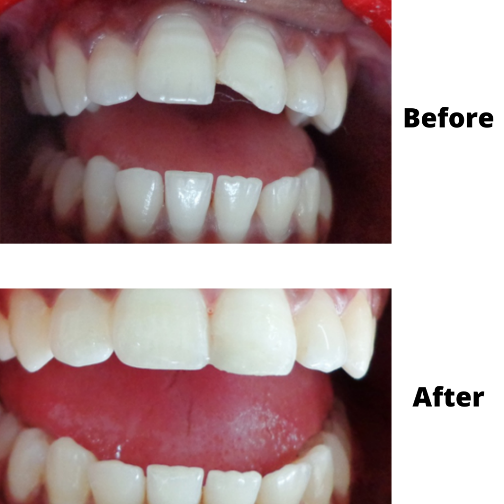 All about front tooth filling