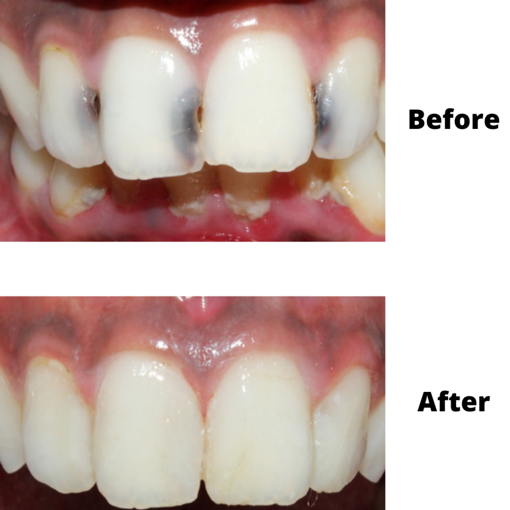 SILVER FILLINGS REPLACED WITH COMPOSITE